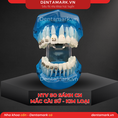 Hàm tư vấn chỉnh nha so sánh chỉnh nha mắc cài Kim loại - mắc cài sứ