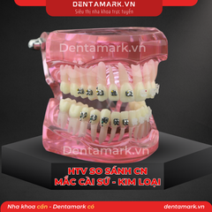 Hàm tư vấn chỉnh nha so sánh chỉnh nha mắc cài Kim loại - mắc cài sứ