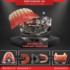 Hàm tư vấn tháo lắp 4 Implant với T Bar Silver - Mẫu hàm tháo lắp trên Implant (Implant All On 4 - T-Bar Silver )