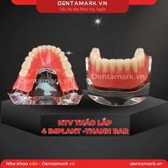 Hàm tư vấn tháo lắp 4 Implant với T Bar Silver - Mẫu hàm tháo lắp trên Implant (Implant All On 4 - T-Bar Silver )