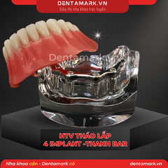 Hàm tư vấn tháo lắp 4 Implant với T Bar Silver - Mẫu hàm tháo lắp trên Implant (Implant All On 4 - T-Bar Silver )