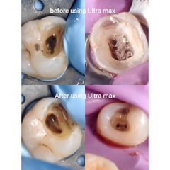 Máy Rung Rửa Siêu Âm Nội Nha ROGIN Ultra MAX 40kHz