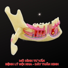 Mô hình giải phẫu tư vấn bệnh lý nội nha - Dây thần kinh