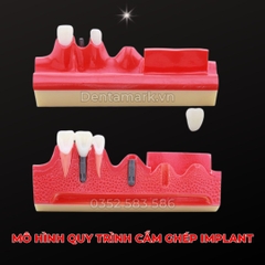 Hàm tư vấn các bước cắm Implant