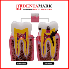 Mô hình so sánh Răng khỏe & Răng sâu