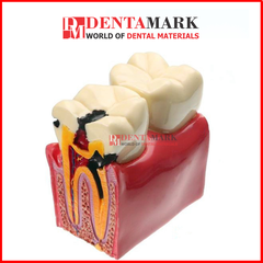 Mô hình so sánh Răng khỏe & Răng sâu