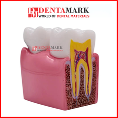 Mô hình so sánh Răng khỏe & Răng sâu