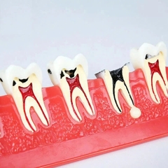 Mô hình tư vấn bệnh lý nội nha - Mô hình giai đoạn sâu răng