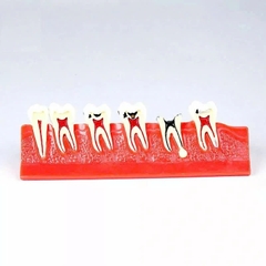 Mô hình tư vấn bệnh lý nội nha - Mô hình giai đoạn sâu răng