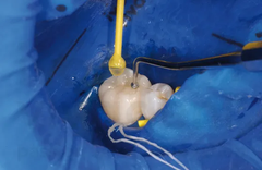 Que Dính Giữ Veneer Ivoclar OptraStick – Hộp 48 Que