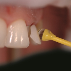 Que Dính Giữ Veneer Ivoclar OptraStick – Hộp 48 Que