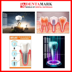 Tranh nha khoa Implant trang trí phòng khám