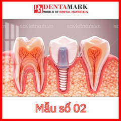 Tranh nha khoa Implant trang trí phòng khám