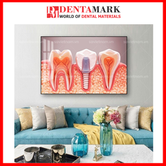 Tranh nha khoa Implant trang trí phòng khám