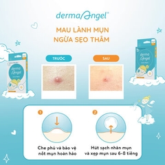 Miếng Dán Mụn Derma Angel Dùng Cho Ngày & Đêm 18 Miếng Acne Patch For Day & Night MB Beauty