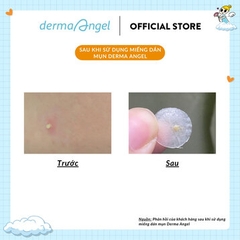 Miếng Dán Mụn Derma Angel Dùng Cho Ngày & Đêm 18 Miếng Acne Patch For Day & Night MB Beauty