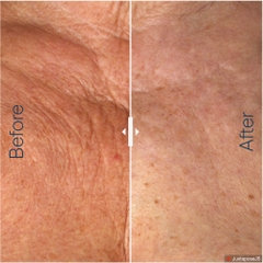 RADIESSE: “Kim Cương Lỏng” Kích Hoạt Sinh Học – Nâng Cơ, Xóa Nhăn và Tái Tạo Collagen Kéo Dài