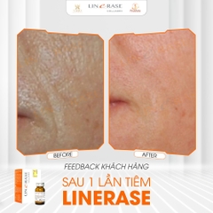 🌟 Linerase Collagen Là Gì? Bí Quyết "Hồi Sinh" Làn Da Chuẩn Y Khoa