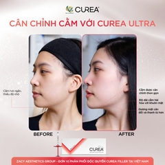 CUREA ULTRA / FILLER TẠO HÌNH CẰM V-LINE, ĐƯỜNG VIỀN HÀM, GÒ MÁ VÀ THÁI DƯƠNG 