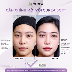 CUREA SOFT / FILLER FILLER TIÊM TẠO HÌNH MÔI, XÓA NẾP GẤP SÂU BỀN VỮNG