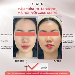 CUREA ULTRA / FILLER TẠO HÌNH CẰM V-LINE, ĐƯỜNG VIỀN HÀM, GÒ MÁ VÀ THÁI DƯƠNG 