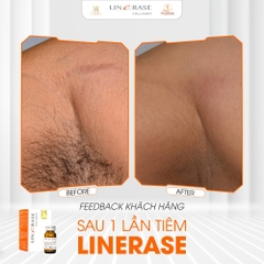 🌟 Linerase Collagen Là Gì? Bí Quyết "Hồi Sinh" Làn Da Chuẩn Y Khoa