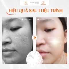 🌟 Linerase Collagen Là Gì? Bí Quyết "Hồi Sinh" Làn Da Chuẩn Y Khoa