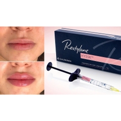 RESTYLANE KYSSE / FILLER TIÊM TẠO HÌNH MÔI VÀ VIỀN MÔI 