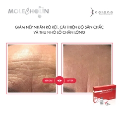 MOLECHOLIN / MESO LÀM SĂN CHẮC, CẢI THIỆN NẾP NHĂN & THU NHỎ LỖ CHÂN LÔNG