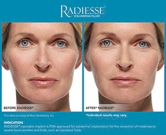 MERZ AESTHETICS RADIESSE / CHẤT LÀM ĐẦY