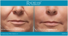 MERZ AESTHETICS RADIESSE / CHẤT LÀM ĐẦY
