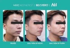 BELOTERO REVIVE / CHẤT LÀM ĐẦY
