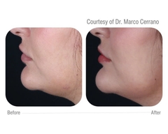 CELLBOOSTER® SHAPE: Phức Hợp Tiêm Tan Mỡ Cục Bộ, Định Hình Vóc Dáng và Cải Thiện Cellulite