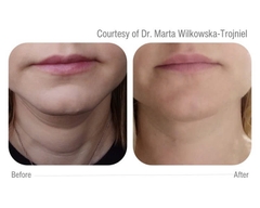 CELLBOOSTER® SHAPE: Phức Hợp Tiêm Tan Mỡ Cục Bộ, Định Hình Vóc Dáng và Cải Thiện Cellulite