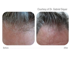 CELLBOOSTER® HAIR: Công Nghệ CHAC Phục Hồi Nang Tóc, Kích Thích Mọc Tóc Chuyên Sâu