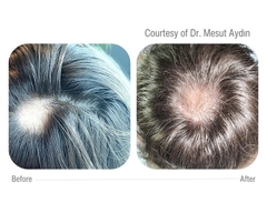 CELLBOOSTER® HAIR: Công Nghệ CHAC Phục Hồi Nang Tóc, Kích Thích Mọc Tóc Chuyên Sâu