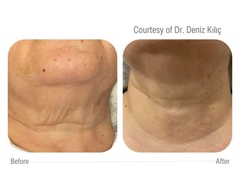 CELLBOOSTER® LIFT: Bí Mật Nâng Cơ & Tái Sinh Làn Da Sâu Từ Bên Trong Với Công Nghệ CHAC Độc Quyền