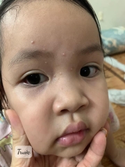 Thuốc đặc trị mụn cóc Thái Lan