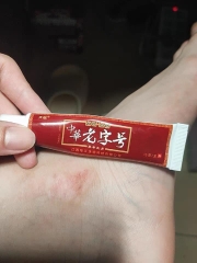 Thuốc bôi Viêm da, á sừng, vẩy nến, lang ben đông y Trung Quốc tuyps 15gr