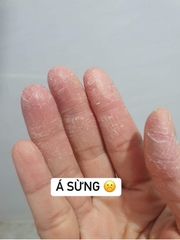 Thuốc bôi Viêm da, á sừng, vẩy nến, lang ben đông y Trung Quốc tuyps 15gr