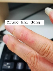 Thuốc bôi Viêm da, á sừng, vẩy nến, lang ben đông y Trung Quốc tuyps 15gr