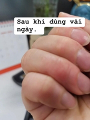 Thuốc bôi Viêm da, á sừng, vẩy nến, lang ben đông y Trung Quốc tuyps 15gr