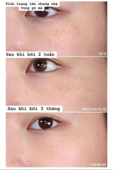 Kem nám Melatoning Cream Hàn Quốc 30ml