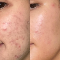 ACNE SCARS