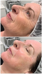 BOTOX