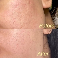 ACNE SCARS