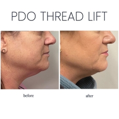 COLLAGEN THREAD LIFT- CĂNG CHỈ COLLAGEN