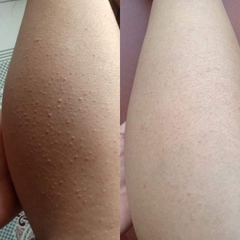 FOLLOCULITIS TREATMENT