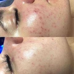 ACNE SCARS