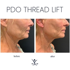 COLLAGEN THREAD LIFT- CĂNG CHỈ COLLAGEN